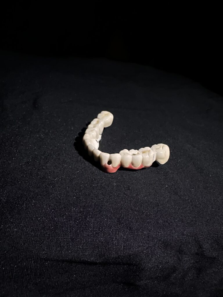 From Missing Teeth to a Complete Smile: Understanding Implant Prostheses img 0423